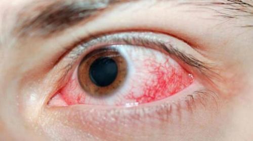 Опухли веки верхние после наращивания ресниц. Что делать, если после наращивания ресниц Ваши веки опухли и начали чесаться? 08