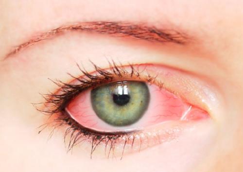 Капли от ожога глаз после наращивания. Химический ожог слизистой глаза после наращивания ресниц