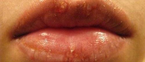 Герпес съедает татуаж губ. Татуаж и герпес