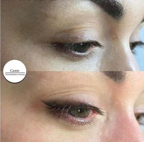 Лазерное удаление стрелок на глазах. Лазерное удаление перманентного макияжа 04 Лазерное удаление стрелок на глазах. Лазерное удаление перманентного макияжа 04