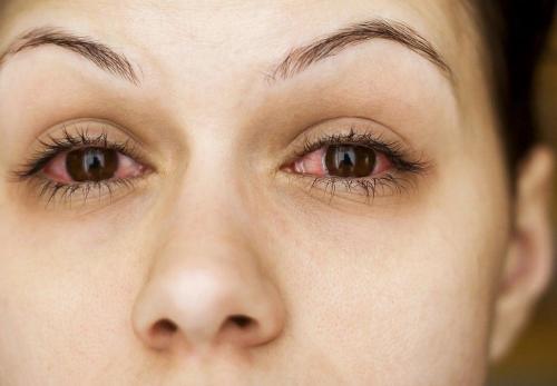 Наращивание ресниц вредно ли для глаз. Последствия наращивания ресниц 05 Наращивание ресниц вредно ли для глаз. Последствия наращивания ресниц 05