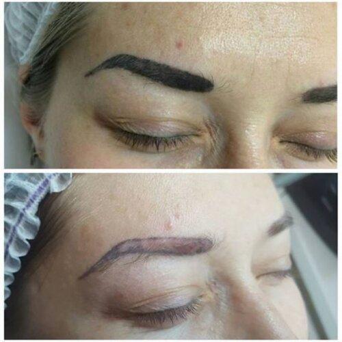 Ремувер состав для удаления татуажа. ВЫВЕДЕНИЕ ТАТУАЖА РЕМУВЕРОМ