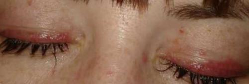 Нарастила ресницы чешутся веки. Почему чешутся веки: ошибки мастера по наращиванию?