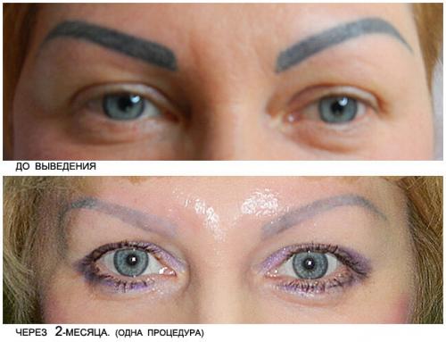 Ремувер состав для удаления татуажа. ВЫВЕДЕНИЕ ТАТУАЖА РЕМУВЕРОМ