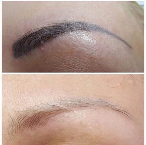 Ремувер состав для удаления татуажа. ВЫВЕДЕНИЕ ТАТУАЖА РЕМУВЕРОМ