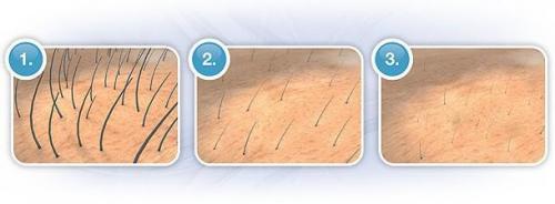 Мужской шугаринг яичек. Шугаринг бикини мужской до и после