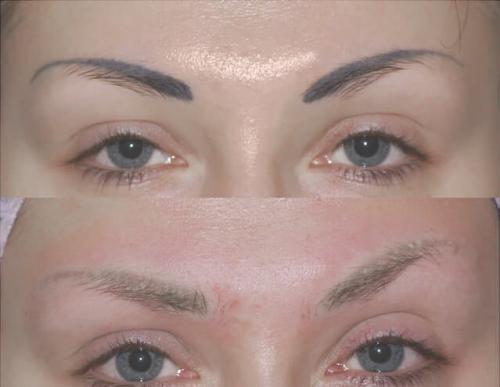 Ремувер состав для удаления татуажа. ВЫВЕДЕНИЕ ТАТУАЖА РЕМУВЕРОМ