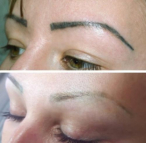 Ремувер состав для удаления татуажа. ВЫВЕДЕНИЕ ТАТУАЖА РЕМУВЕРОМ