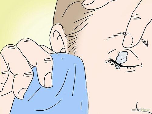 Что будет если капнуть супер клей в глаз. Что делать, если клей попал в глаз