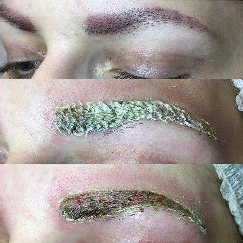 Ремувер состав для удаления татуажа. ВЫВЕДЕНИЕ ТАТУАЖА РЕМУВЕРОМ