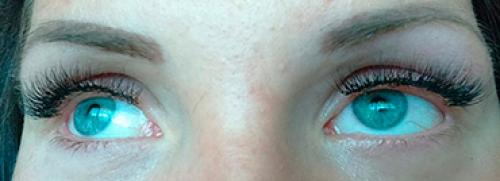 Что делать если в глаз попал клей для наращивания ресниц. Химический ожог слизистой глаза после наращивания ресниц