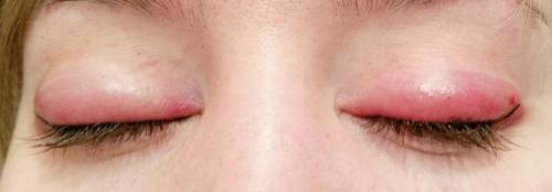 Как снять отек с век после татуажа. Симптомы отека век и бровей после татуажа 01 Как снять отек с век после татуажа. Симптомы отека век и бровей после татуажа 01