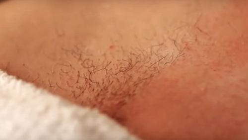 Мужской шугаринг яичек. Шугаринг бикини мужской до и после