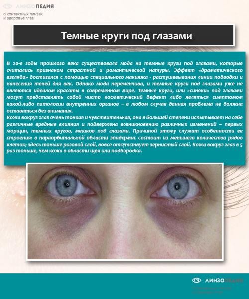 Что делать если темные круги под глазами. Как от них избавиться?