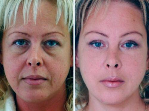 Что делать если темные круги под глазами. Как от них избавиться?