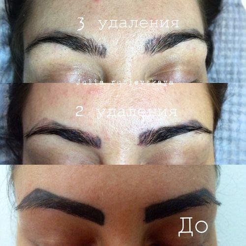 Кровоподтеки после лазерного удаления татуажа. Все про брови после удаление татуажа лазером: рекомендации косметолога