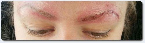 Кровоподтеки после лазерного удаления татуажа. Все про брови после удаление татуажа лазером: рекомендации косметолога