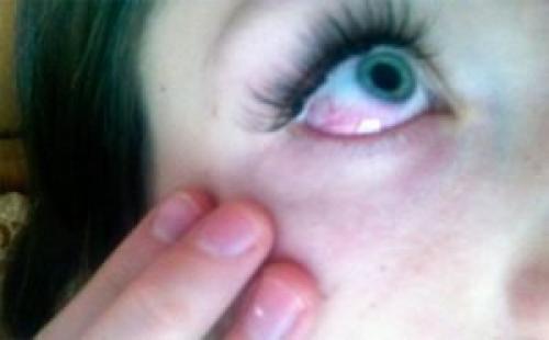 Клей для ресниц попал в глаза. Если в глаз попал суперклей 03