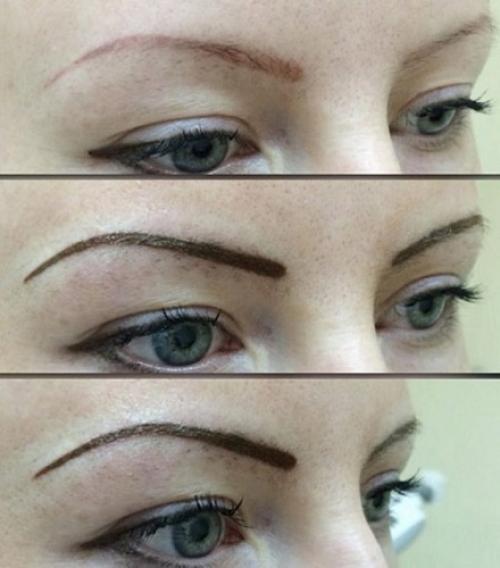 Брови после удаления лазером татуажа. О практическом опыте 19 Брови после удаления лазером татуажа. О практическом опыте 19