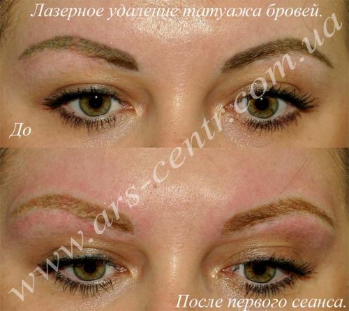 Отек после лазерного удаления татуажа. Отек глаз после татуажа. Лазерн