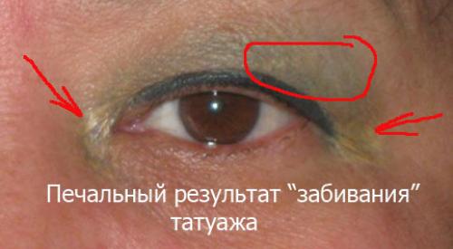 Отек после лазерного удаления татуажа. Отек глаз после татуажа. Лазерн