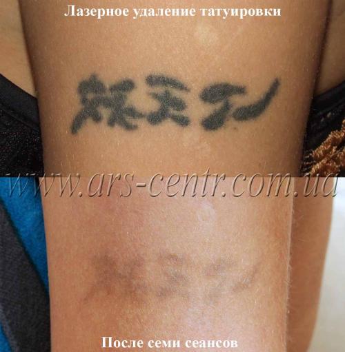 Отек после лазерного удаления татуажа. Отек глаз после татуажа. Лазерн