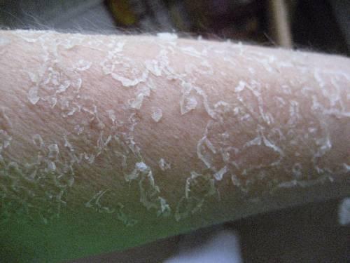 Шелушатся брови и крылья носа. Почему появляется шелушение?