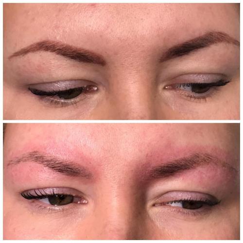 После удаления татуажа бровей лазером уход. Уход после лазерного удаления татуажа 14 После удаления татуажа бровей лазером уход. Уход после лазерного удаления татуажа 14