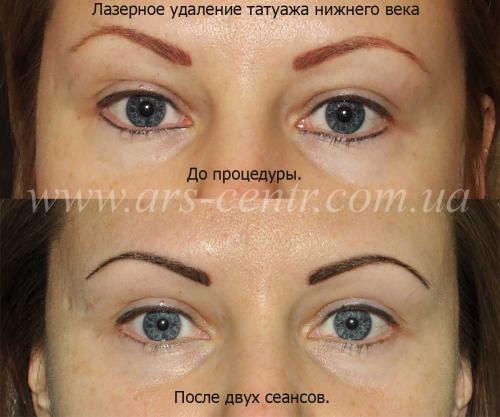 Отек после лазерного удаления татуажа. Отек глаз после татуажа. Лазерн