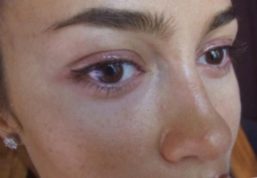 Снять отек после татуажа век. Как снять отек после татуажа