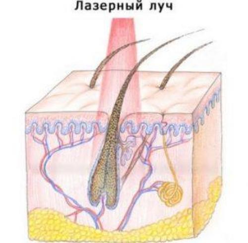Перед лазерной эпиляцией нужно бриться. Перед лазерной эпиляцией надо бриться