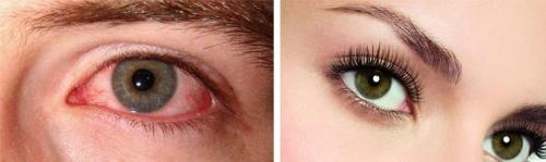 Клей для ресниц попал в глаза. Если в глаз попал суперклей 02