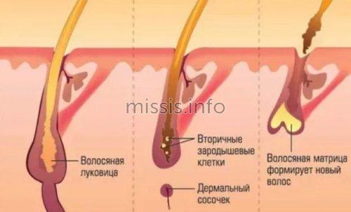 Последствия Лазерной эпиляции в зоне бикини. Что такое лазерная эпиляция зоны бикини? 02 Последствия Лазерной эпиляции в зоне бикини. Что такое лазерная эпиляция зоны бикини? 02