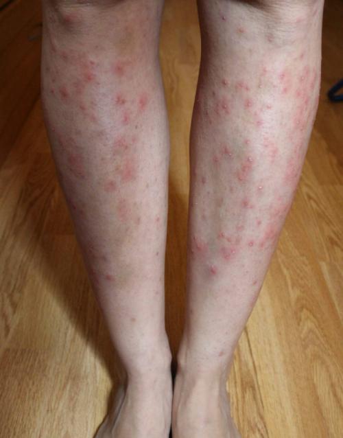 Красные точки после лазерной эпиляции. В чем причина раздражения после процедуры?