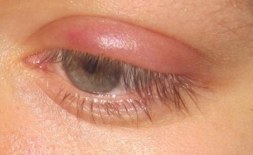 Опухло нижнее веко после наращивания ресниц. Что делать, если после наращивания ресниц опухло веко?