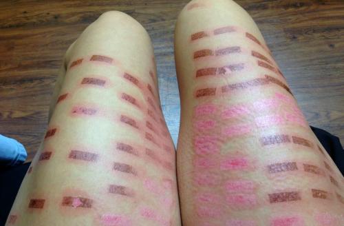 Воспаление лимфоузлов после Лазерной эпиляции. 5 побочных эффектов после Лазерной Эпиляции.