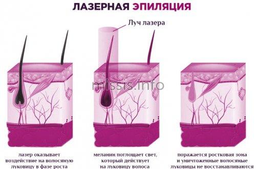 Последствия Лазерной эпиляции в зоне бикини. Что такое лазерная эпиляция зоны бикини? 01 Последствия Лазерной эпиляции в зоне бикини. Что такое лазерная эпиляция зоны бикини? 01