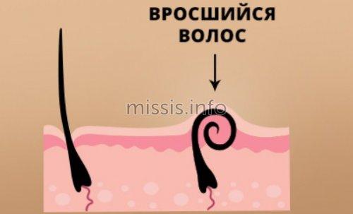 Последствия Лазерной эпиляции в зоне бикини. Что такое лазерная эпиляция зоны бикини? 03 Последствия Лазерной эпиляции в зоне бикини. Что такое лазерная эпиляция зоны бикини? 03