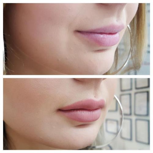 Больно ли губы делать. Разнообразие процедур по увеличению губ 08