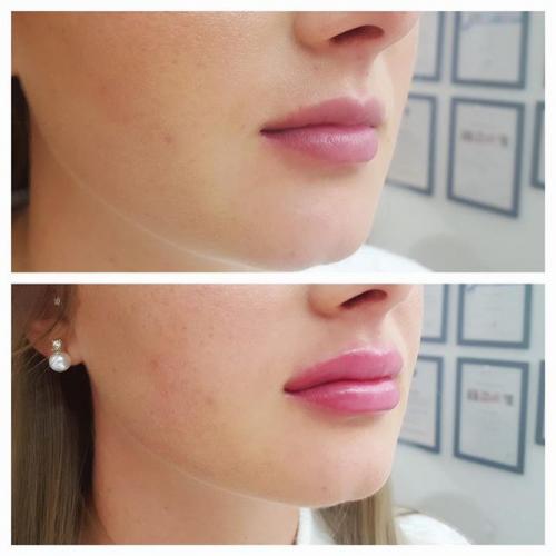 Больно ли губы делать. Разнообразие процедур по увеличению губ 09