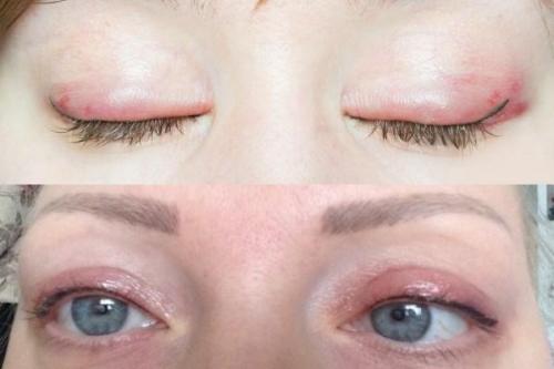 Опухшие веки после перманентного макияжа. Как убрать отек глаз после татуажа век и сохранить зрение?