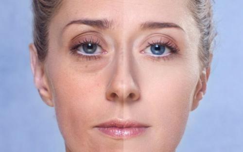 Опухшие веки после сна причины. Когда стоит бить тревогу при опухании век?