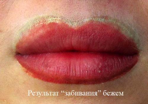 Отек после лазерного удаления татуажа. Отек глаз после татуажа. Лазерн