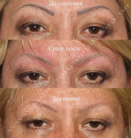 Отек после лазерного удаления татуажа. Отек глаз после татуажа. Лазерн