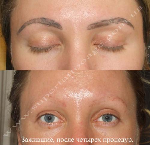 Отек после лазерного удаления татуажа. Отек глаз после татуажа. Лазерн