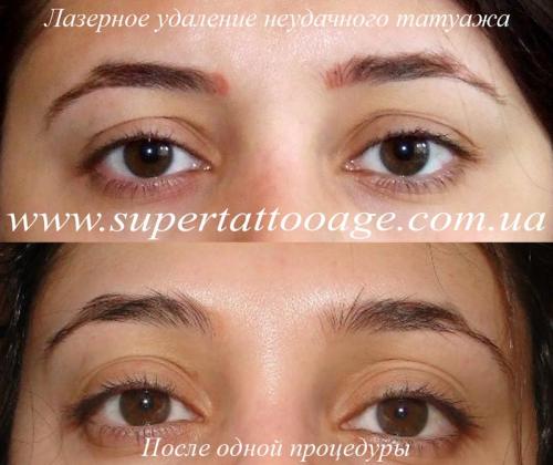 Отек после лазерного удаления татуажа. Отек глаз после татуажа. Лазерн