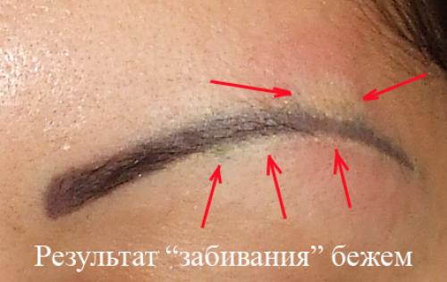 Отек после лазерного удаления татуажа. Отек глаз после татуажа. Лазерн