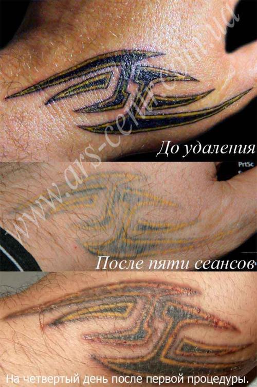 Отек после лазерного удаления татуажа. Отек глаз после татуажа. Лазерн