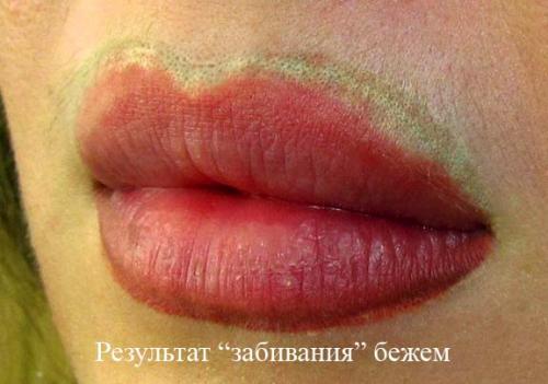 Отек после лазерного удаления татуажа. Отек глаз после татуажа. Лазерн