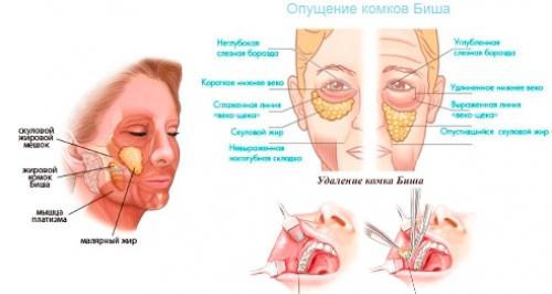 Удаление комков Биша последствия в старости. Удаление Комков Биша. мой опыт.